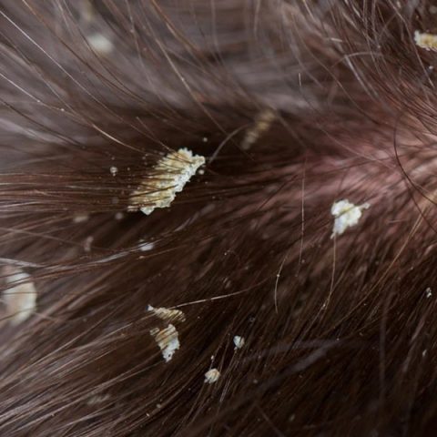 How to Get Rid of Dandruff