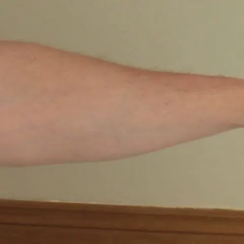 Do Boil Scars Ever Go Away?